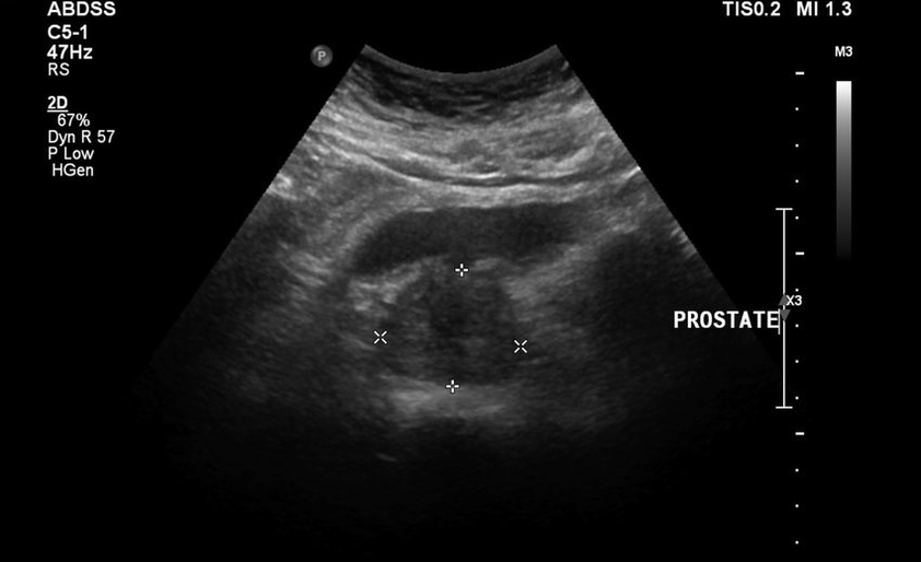 Prostatitis for ultrasound before taking Urosaf