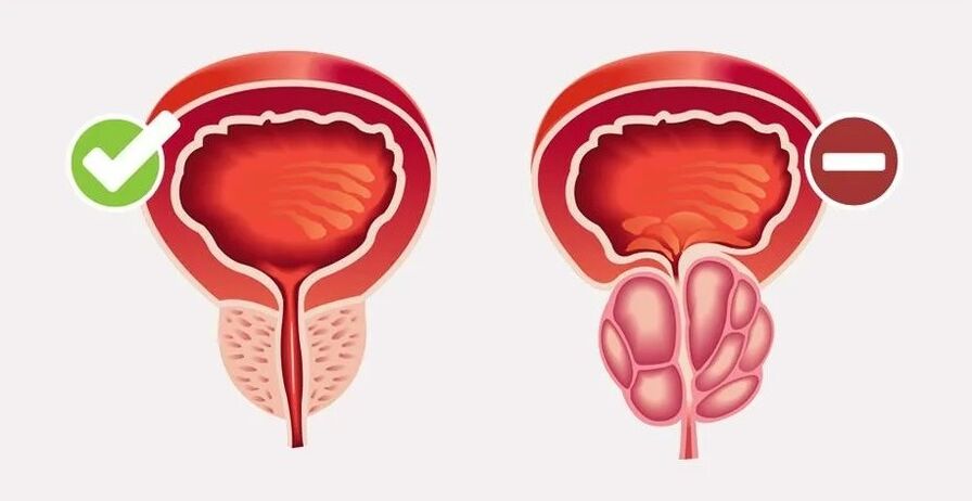 Prostatitis in men