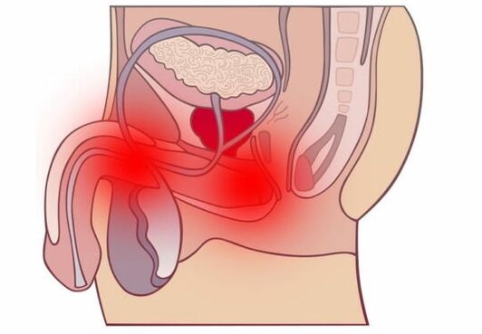Acute prostatitis