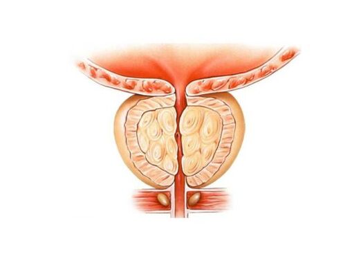 Increased prostatis prostate