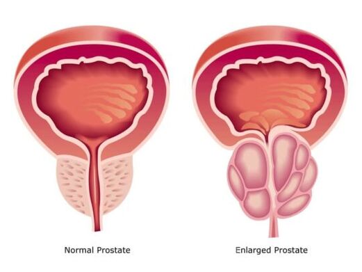 Normal and increased prostate